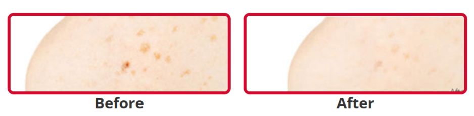 Illuminatural 6i Before and After