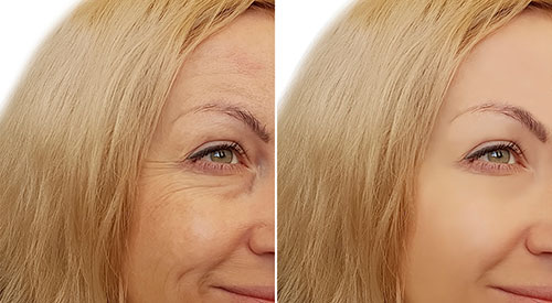eyes-wrinkles-before-after
